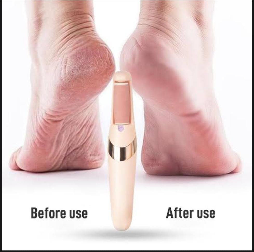 Foot Fix™ Callus Remover